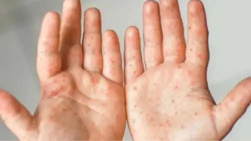 ¿Cómo prevenir el contagio del virus coxsackie? Especialista del Minsa responde