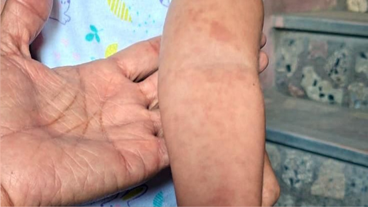 Lambayeque: detectan primer caso de sarampión en la región y activan cerco epidemiológico