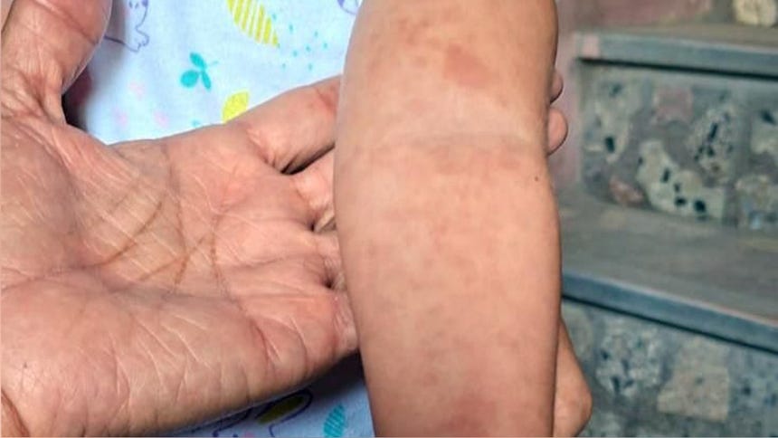 A Decade of Silence Broken by Confirmed Measles Cases