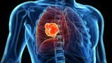 Perú registra más muertes que antes de la pandemia: cáncer lidera pese a un aumento de 62% en gasto para prevenirlo, ¿cómo corregir?