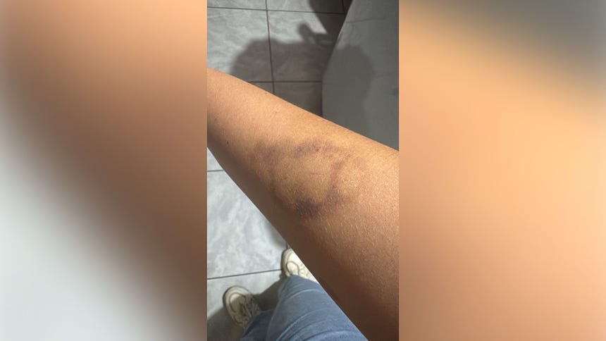 Una foto que compartió Pamela Almenara en la que se vislumbra un moretón producto de una supuesta agresión del niño en su contra.