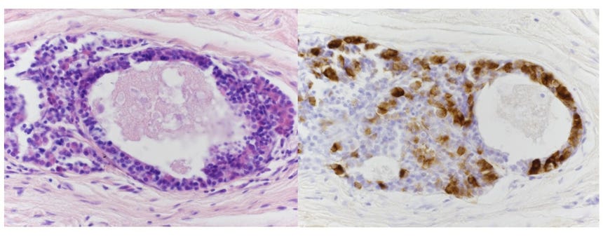 Cambios en el tejido transplantado luego de tres meses.
