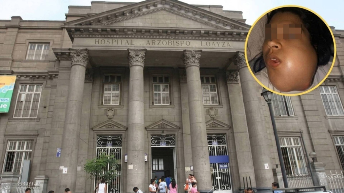 Lima: joven con tumor en la mandíbula izquierda necesita urgente operación