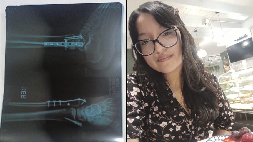 Joven de 25 años solicita el retiro urgente de tornillos en el tobillo tras sufrir severos dolores [VIDEO]